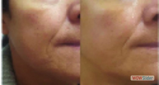 Microneedling Face Lift